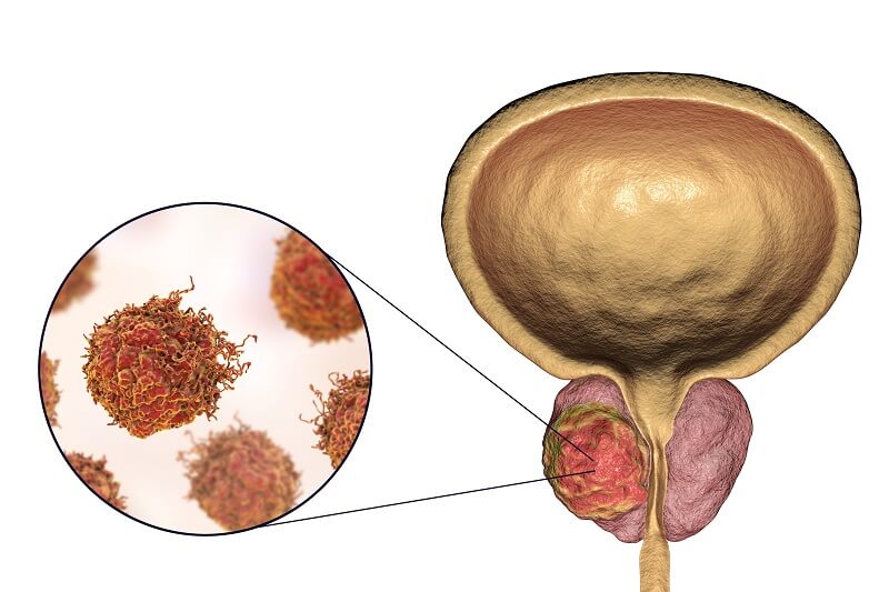 Illustration einer Prostata mit Krebsgewebe